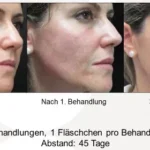 Sculptra Negative Erfahrungen Risiken, Nebenwirkungen und echte Erfahrungsberichte (1)