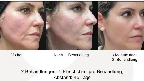 Sculptra Negative Erfahrungen Risiken, Nebenwirkungen und echte Erfahrungsberichte (1)