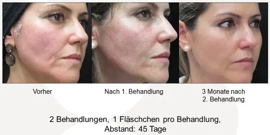 Sculptra Negative Erfahrungen Risiken, Nebenwirkungen und echte Erfahrungsberichte (1)